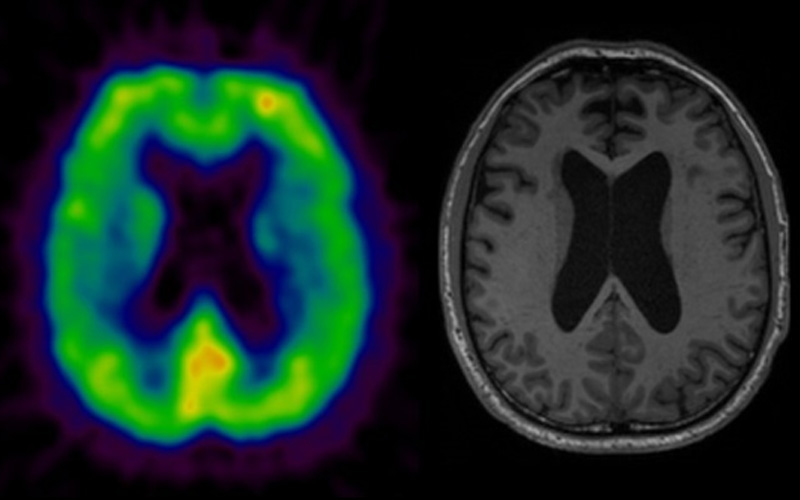 Astroglial Activation, β-amyloid Deposition and Neuronal Activity in AD