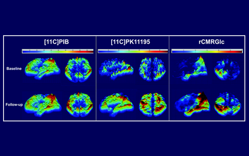 Microglial Activation in Alzheimer’s Disease and Mild Cognitive Impairment