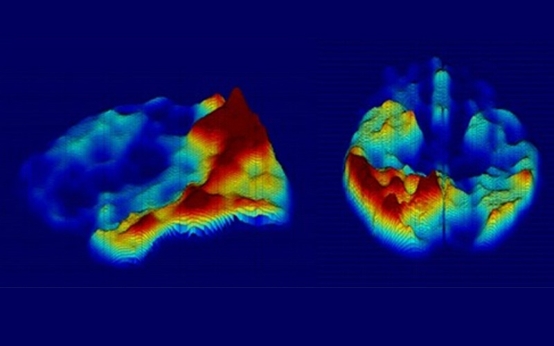 Evaluating Liraglutide (diabetes drug) in Patients with Alzheimer's Disease